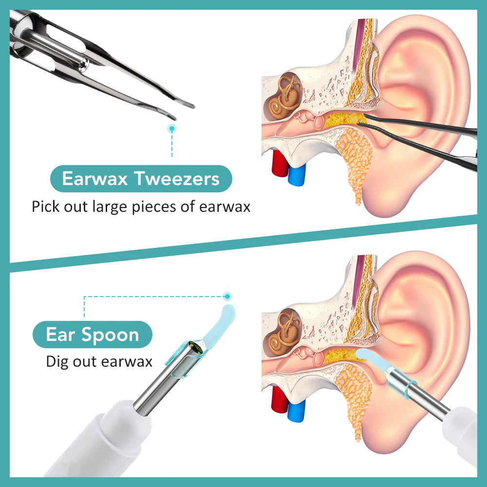 WaxWand - WiFi Elimination Otoscope